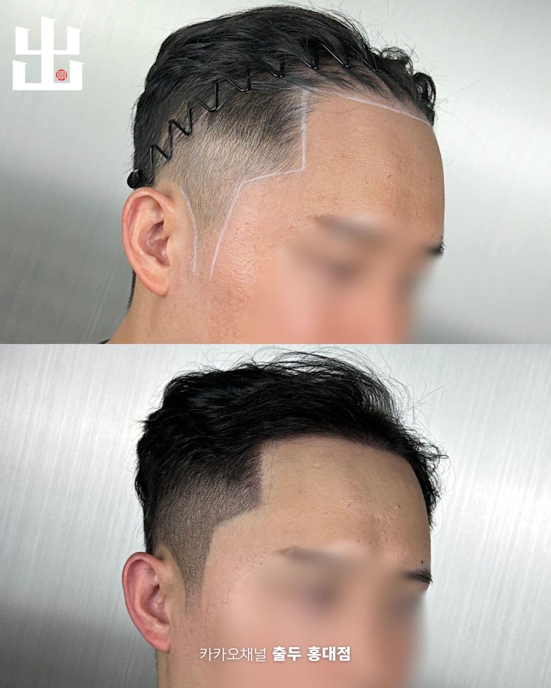 측면 헤어라인 디자인 후 두피문신 결과