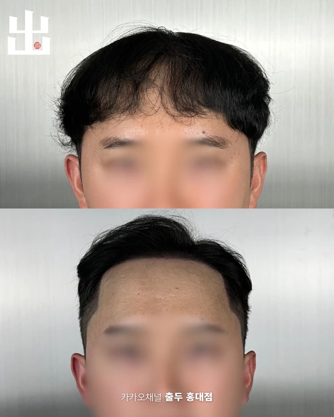 M자 이마 두피문신 정면 전후 비교