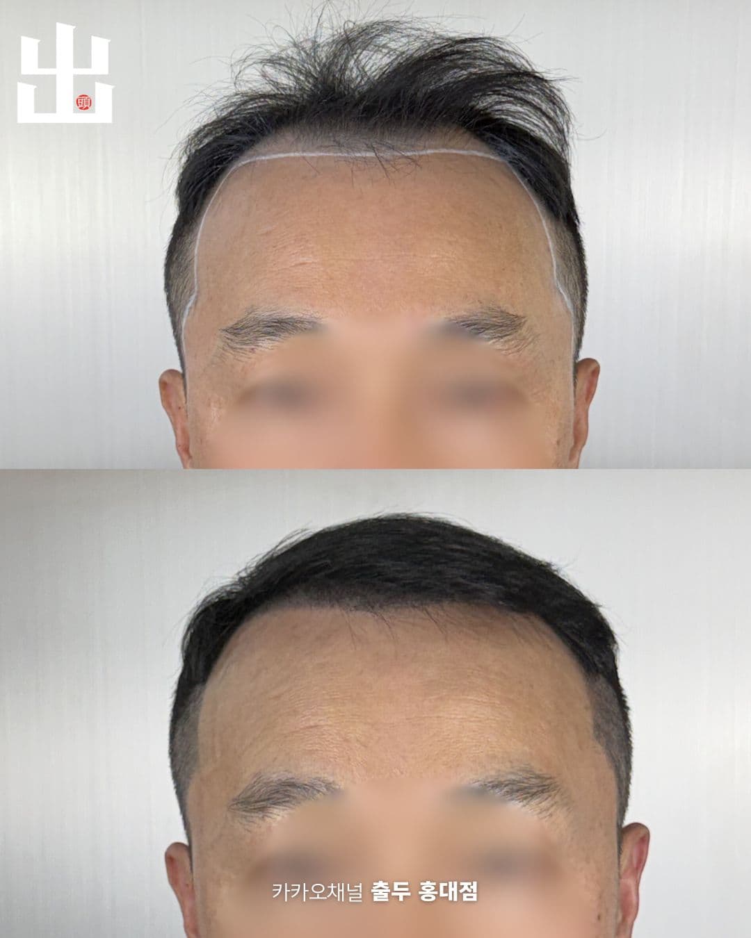 M자 헤어라인 교정 두피문신 전후