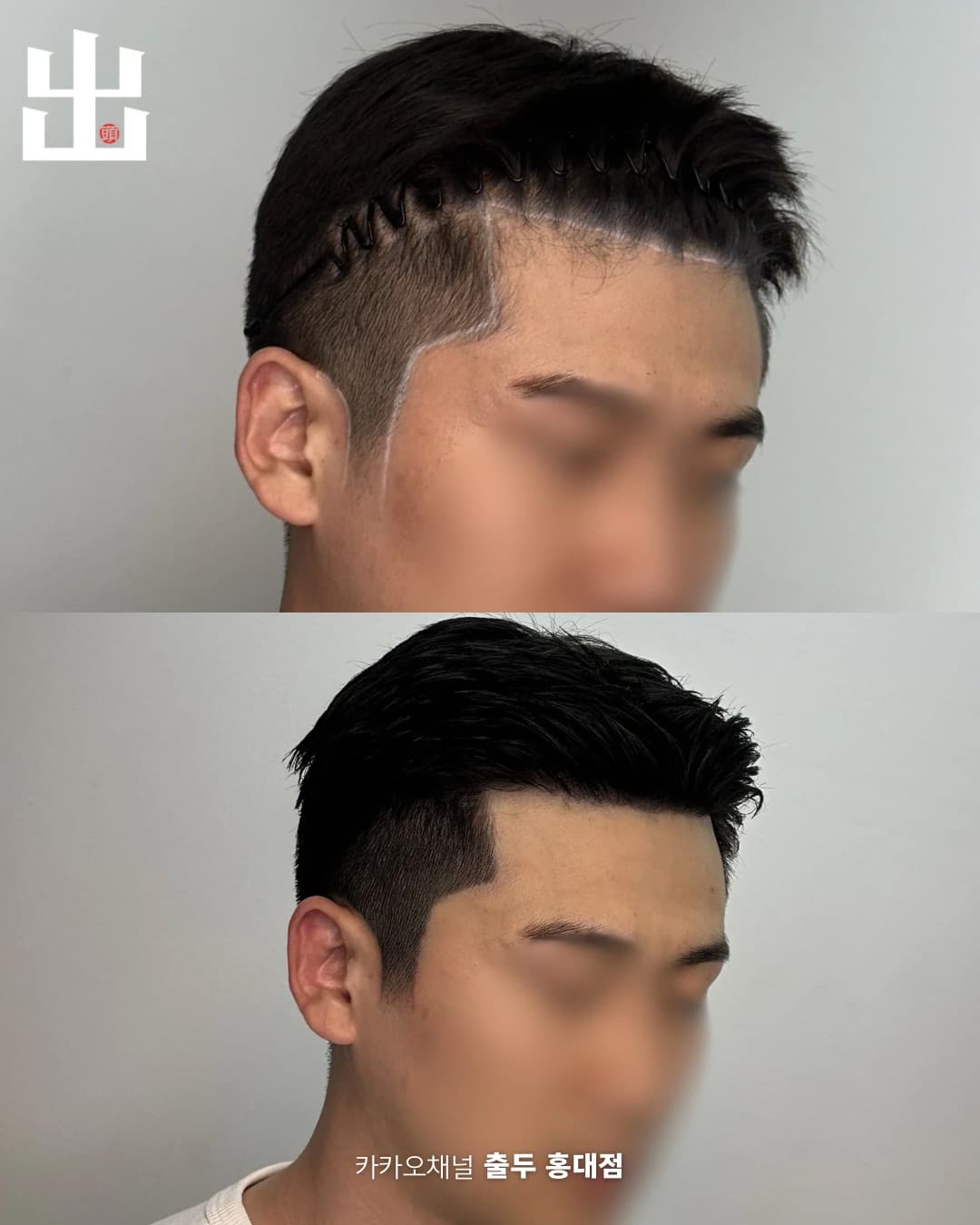 측면 헤어라인 SMP 시술 전후 비교