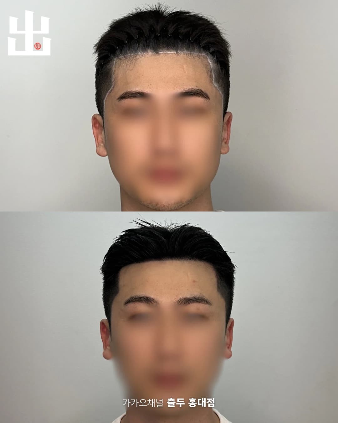 정면 헤어라인 두피문신 자연스러운 결과