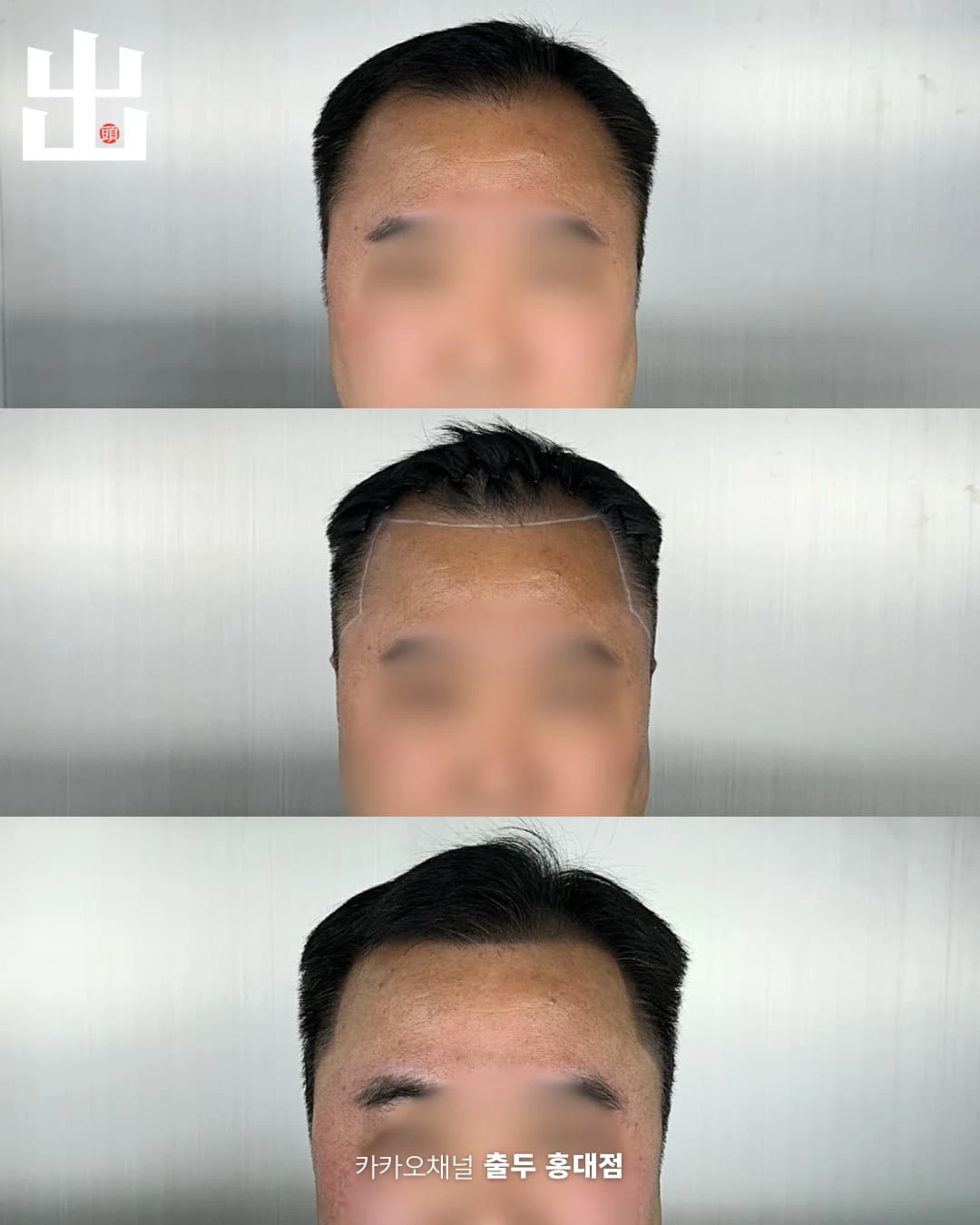 두피문신 정면 단계별 변화 - 시술 전 디자인 완성