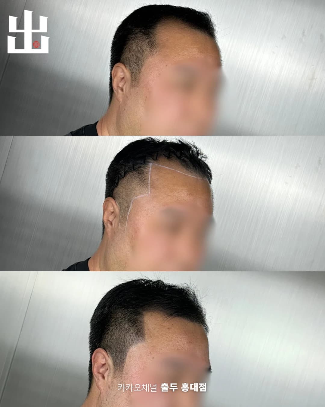 두피문신 측면 단계별 변화 - 시술 전 디자인 완성