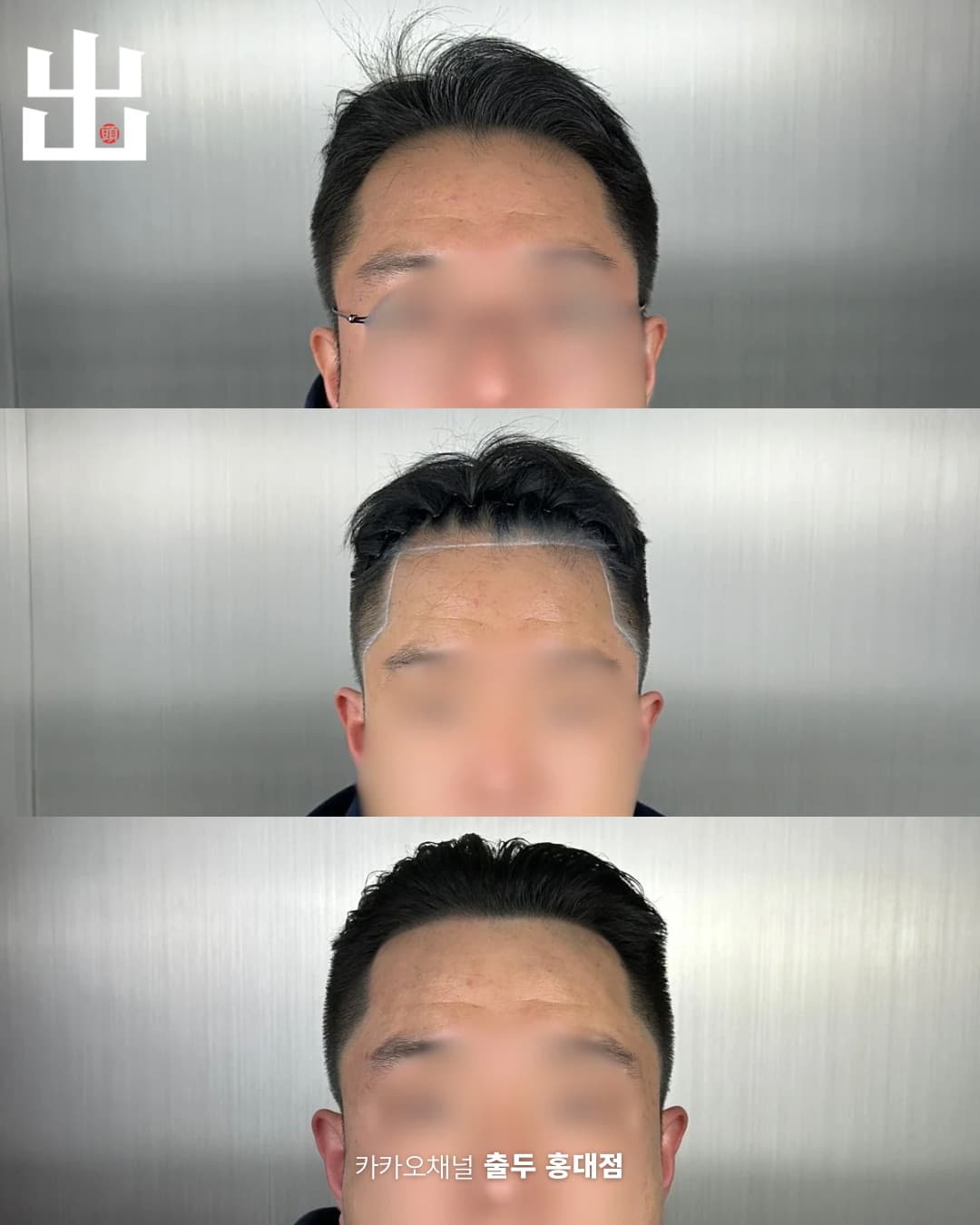 헤어라인 두피문신 정면 단계별 시술 과정