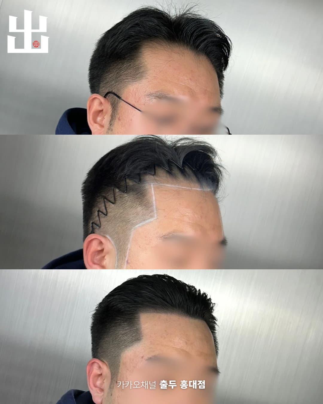 헤어라인 두피문신 측면 단계별 시술 과정