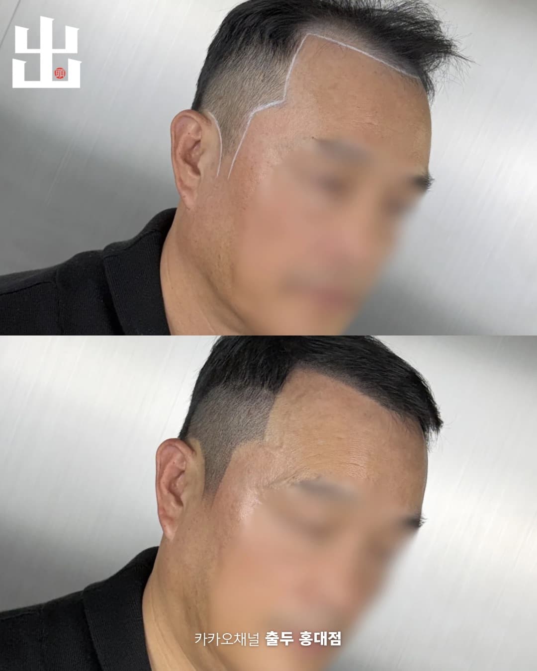 중년 남성 헤어라인 SMP 시술 전후