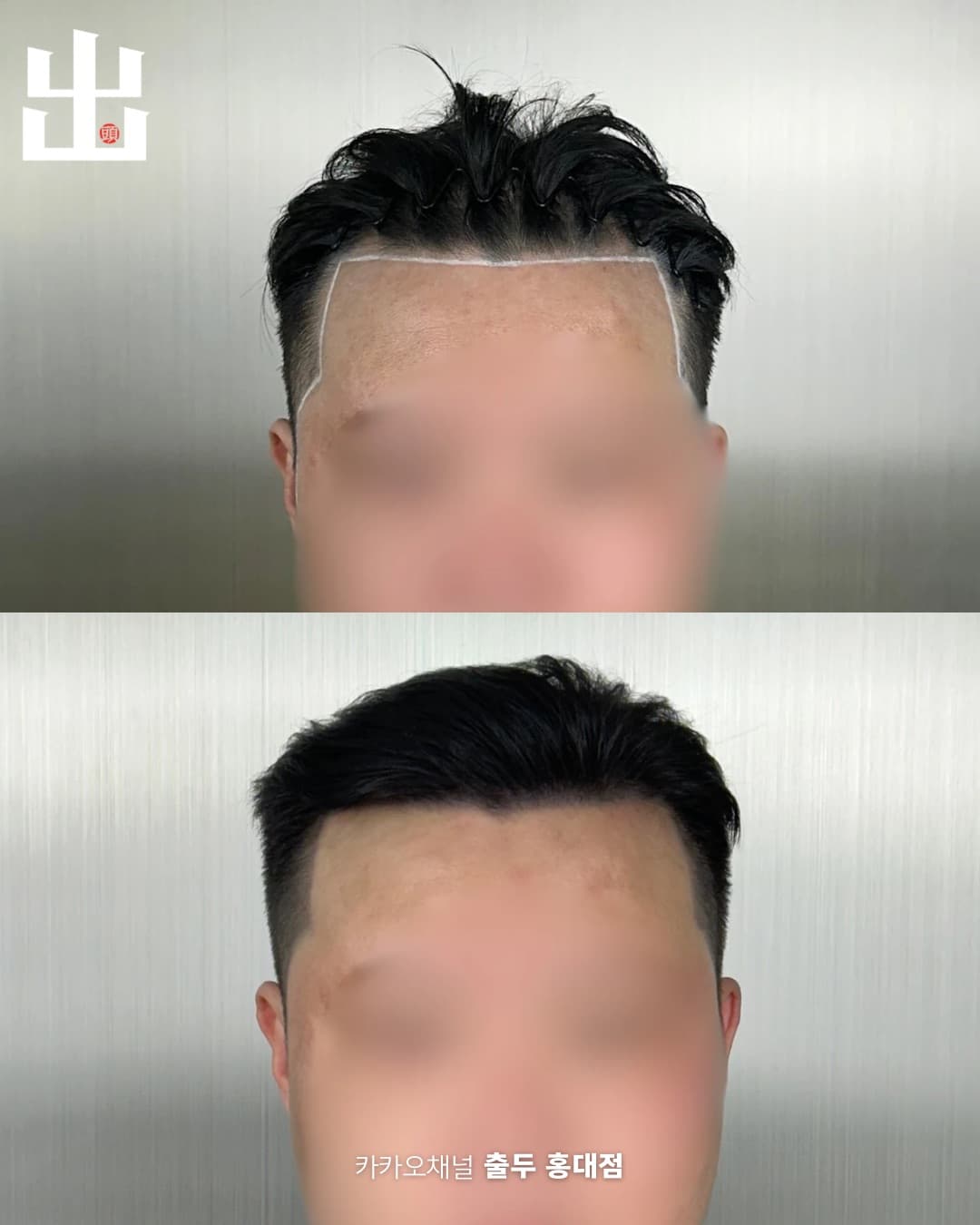 홍대 두피문신 헤어라인 정면 시술 결과