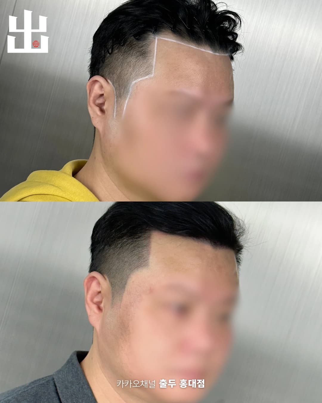 M자 이마 SMP 측면 시술 전후 비교