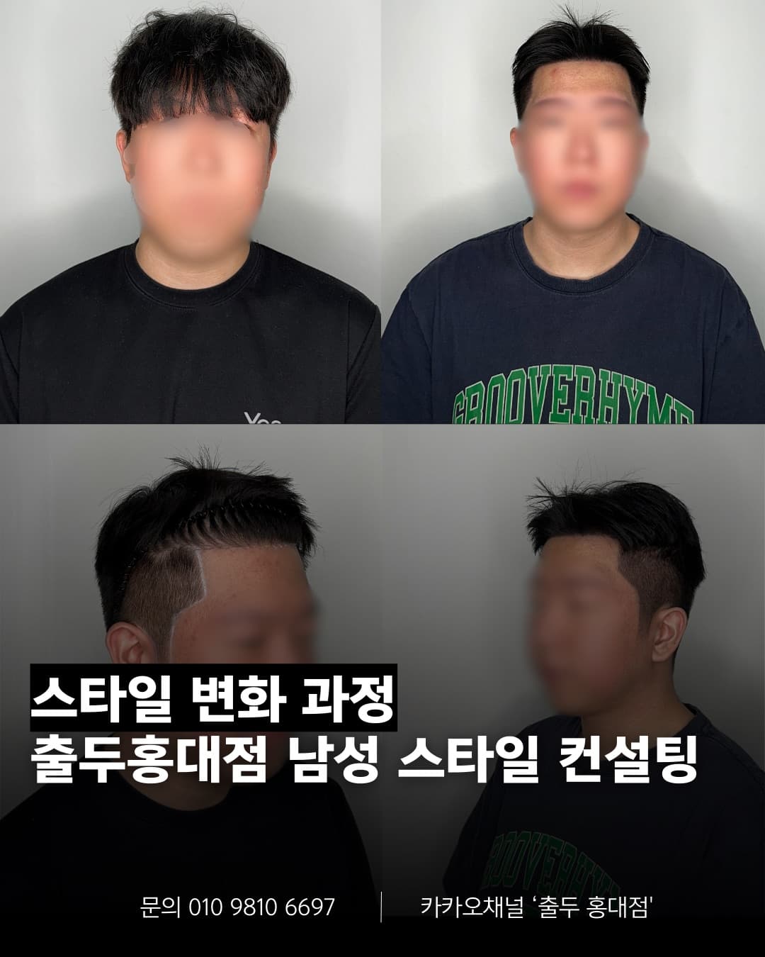 스칼프 마이크로피그먼테이션 시술 결과