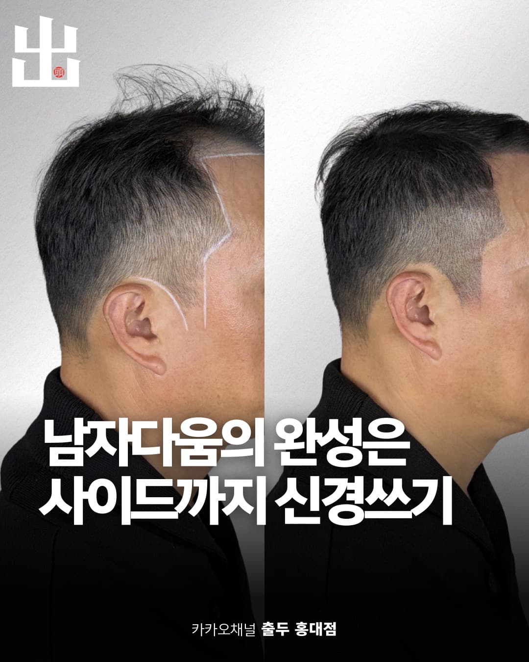 홍대 두피문신 정수리 시술 사례