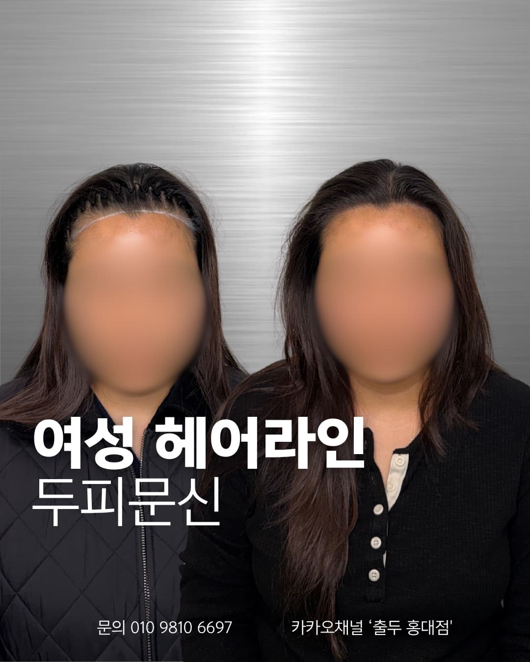 남성 탈모 두피문신 커버 결과