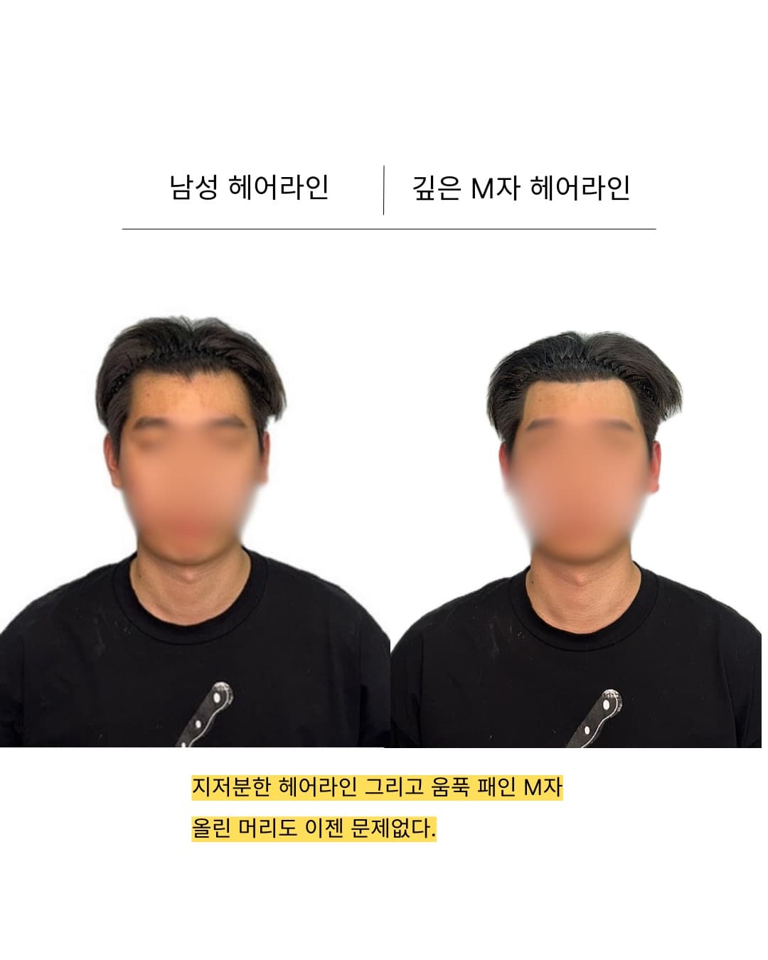 홍대 SMP 전후 비교 사진