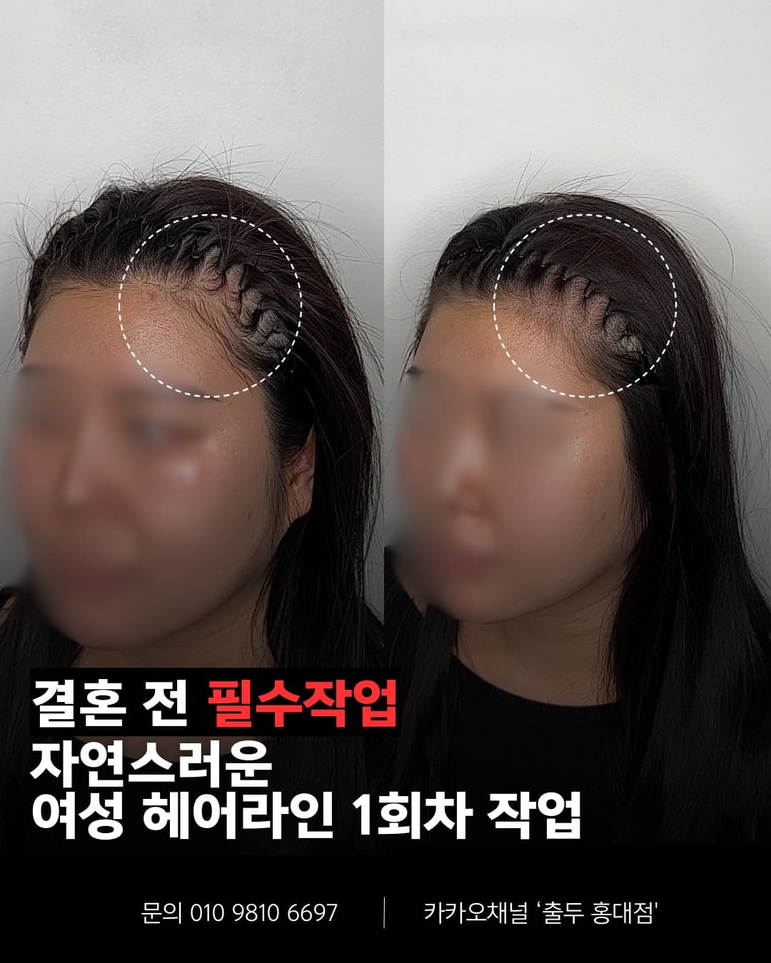 홍대 두피문신 숱채움 결과