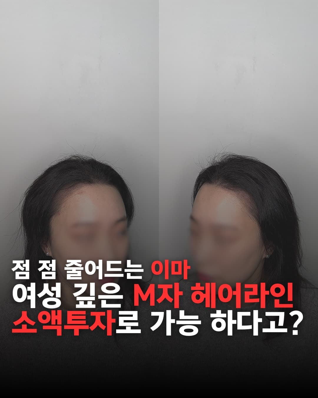 출두 SMP 헤어라인 교정 결과