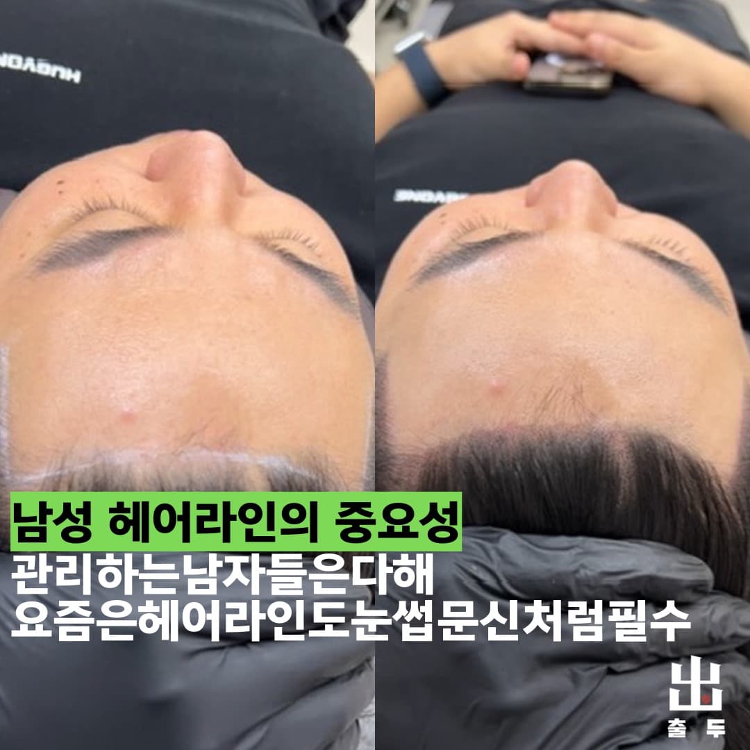 두피문신 자연스러운 밀도 표현